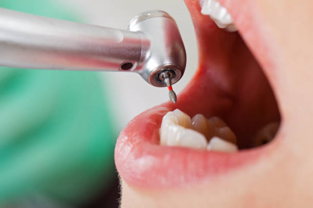 Best Emergency Dentist for Lost Fillings or Crowns in Framingham, MA